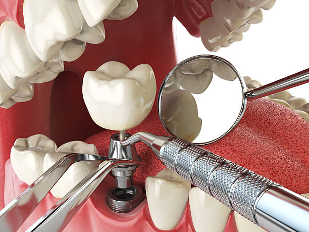 Best Emergency Root Canal Therapy in Shelbyvle, IL