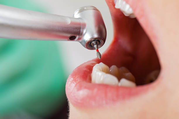 Best Emergency Root Canal Therapy in Shelbyvle, IL